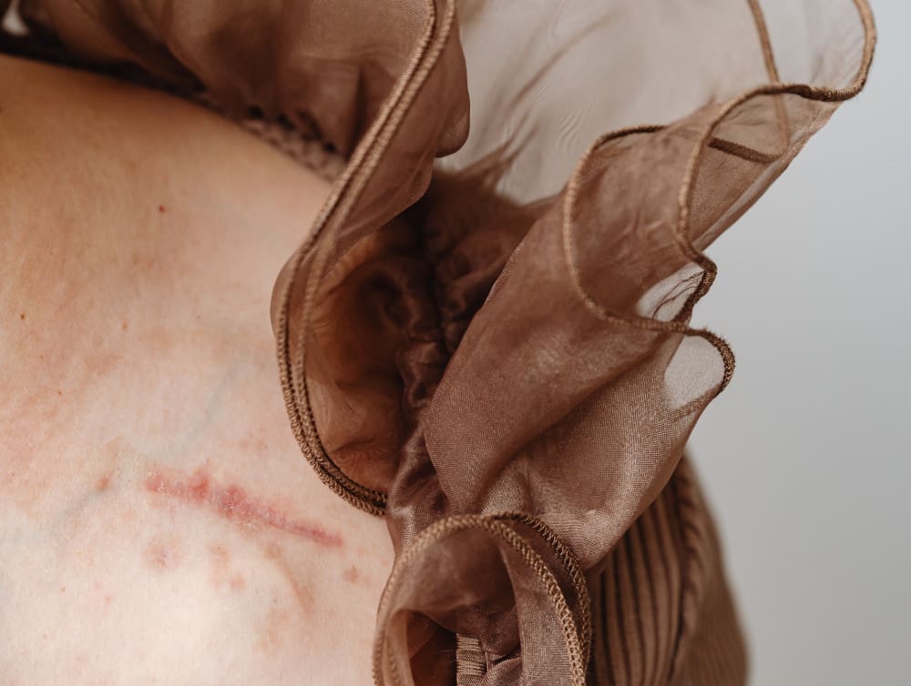 Scars Scars